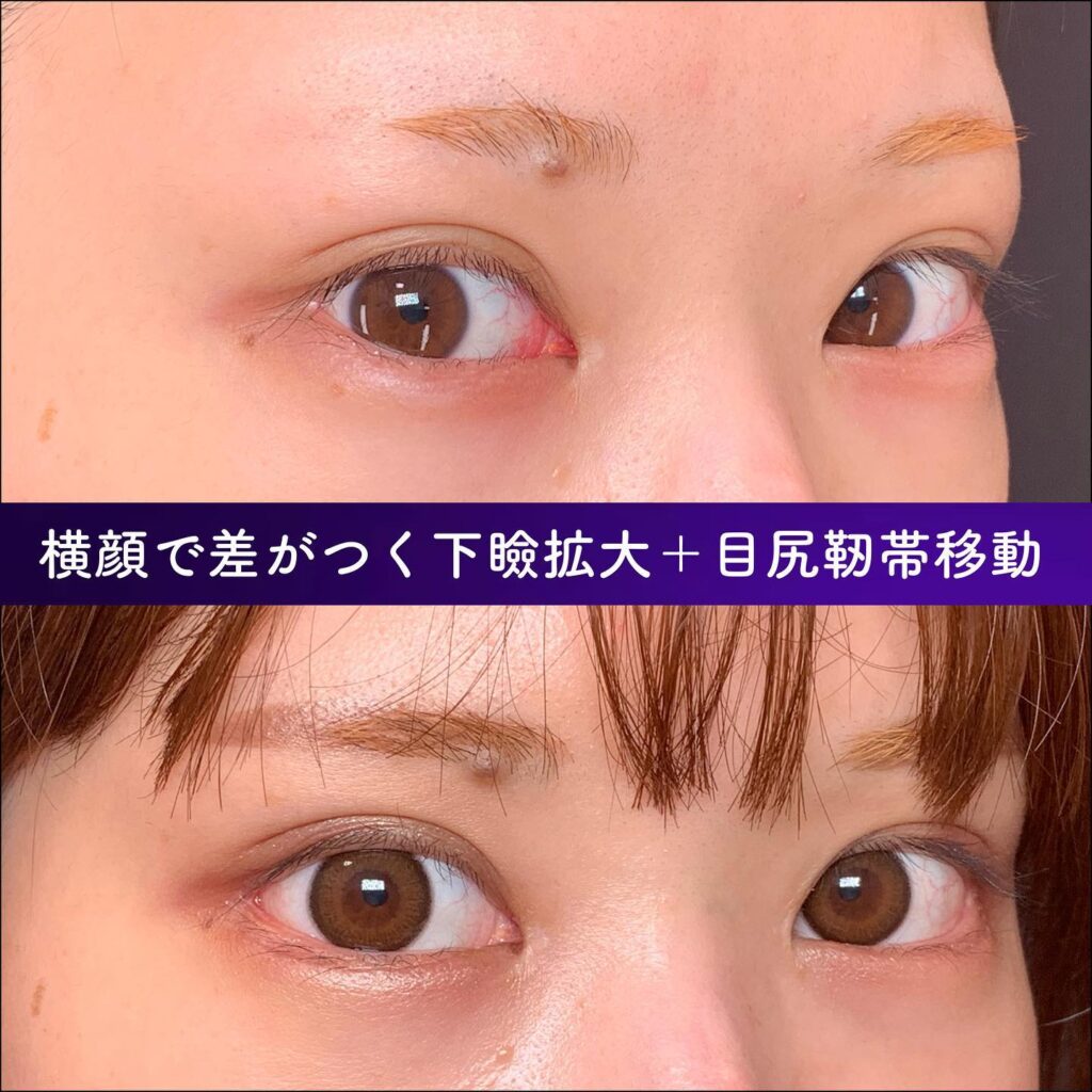 目尻切開とグラマラス形成の症例写真 (1)