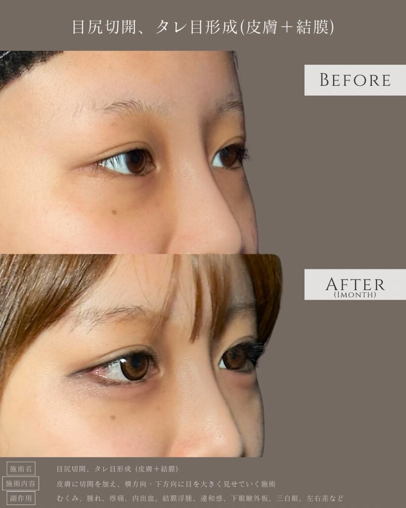 目尻切開とタレ目形成の症例写真 (8)