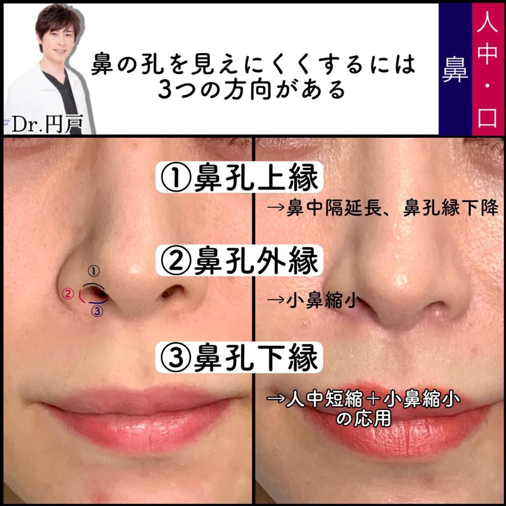 人中短縮と小鼻縮小の症例写真 (2)