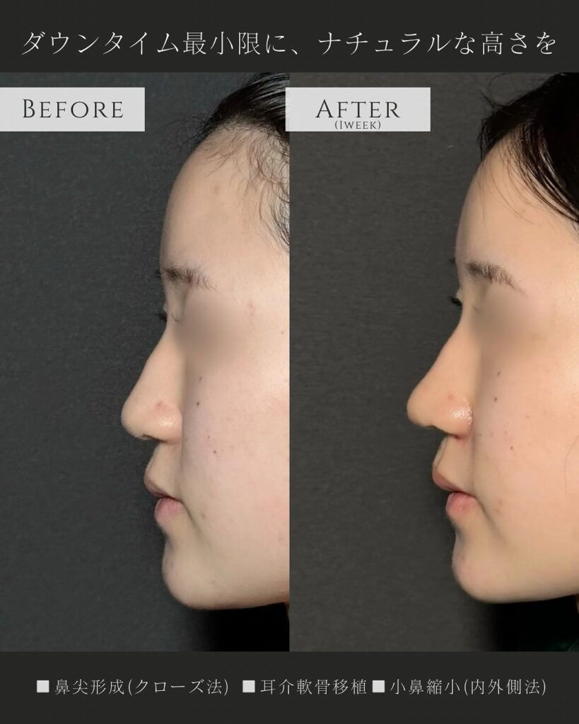鼻尖形成と耳介軟骨移植と小鼻縮小の症例写真 (13)