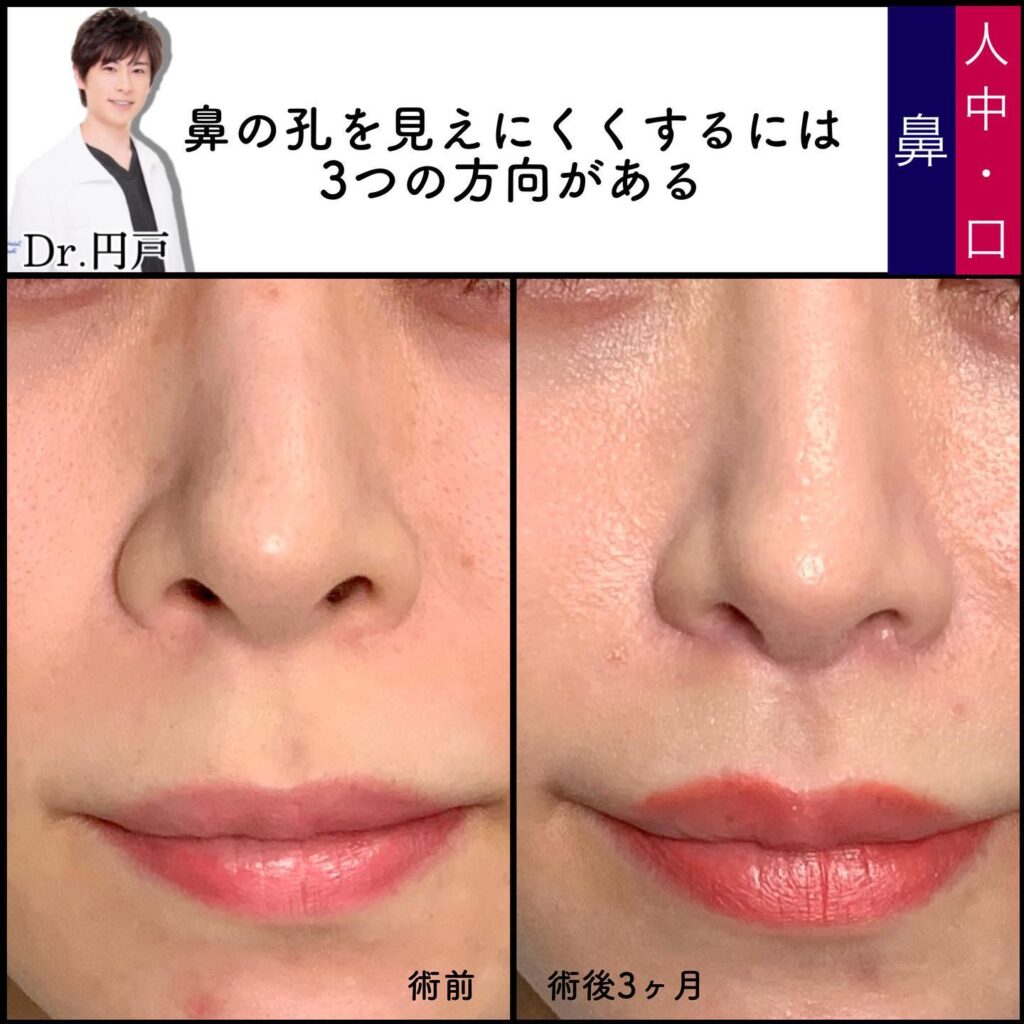 人中短縮と小鼻縮小の症例写真 (4)