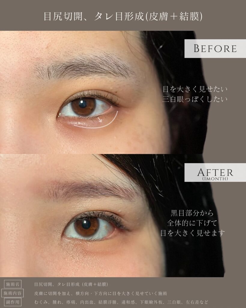 目尻切開とタレ目形成の症例写真 (38)