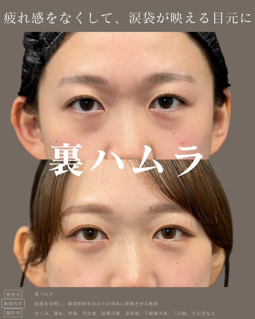 裏ハムラ法の症例写真 (1)