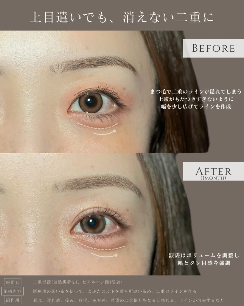 自然癒着法と涙袋のヒアルロン酸の症例写真 (5)