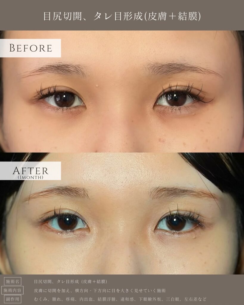 目尻切開とタレ目形成の症例写真 (2)