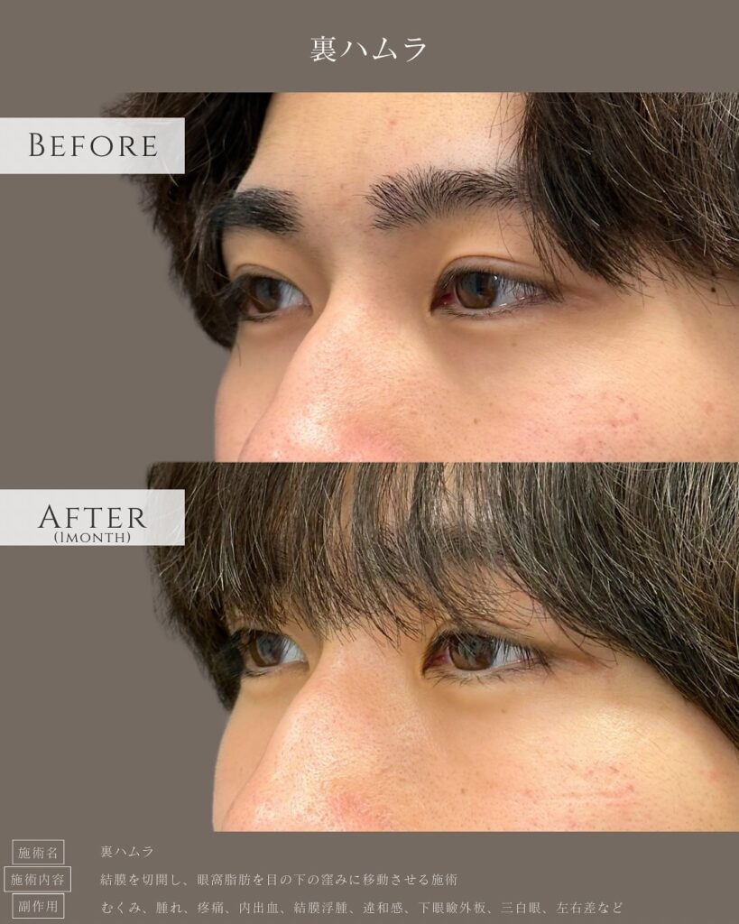 裏ハムラ法を受けた男性の症例写真 (5)