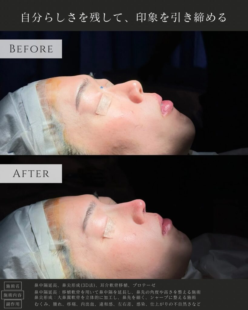 鼻中隔延長と鼻尖形成と耳介軟骨磯久とプロテーゼの症例写真 (2)