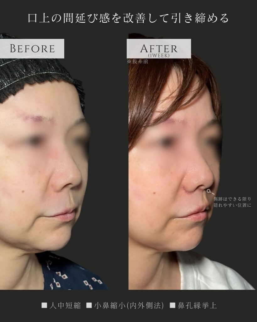 人中短縮と小鼻縮小と鼻孔縁挙上の症例写真 (2)