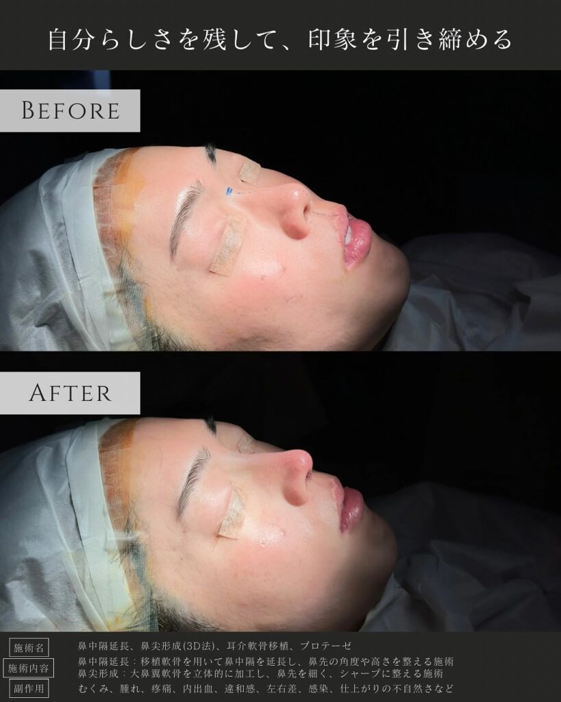 鼻中隔延長と鼻尖形成と耳介軟骨磯久とプロテーゼの症例写真 (3)
