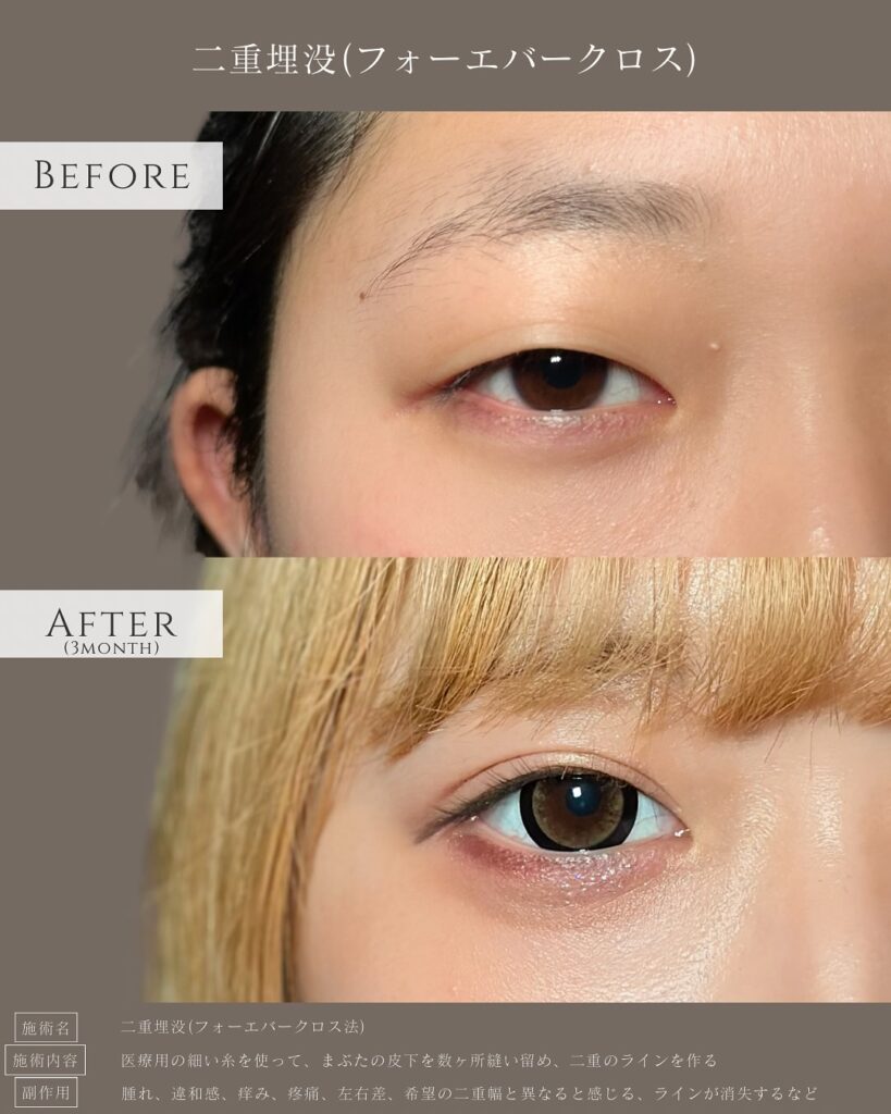 埋没法の症例写真 (7)