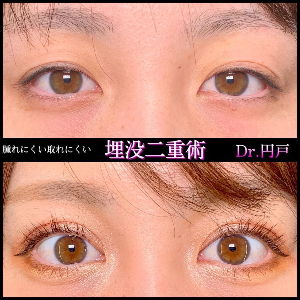 埋没法の症例写真 (7)