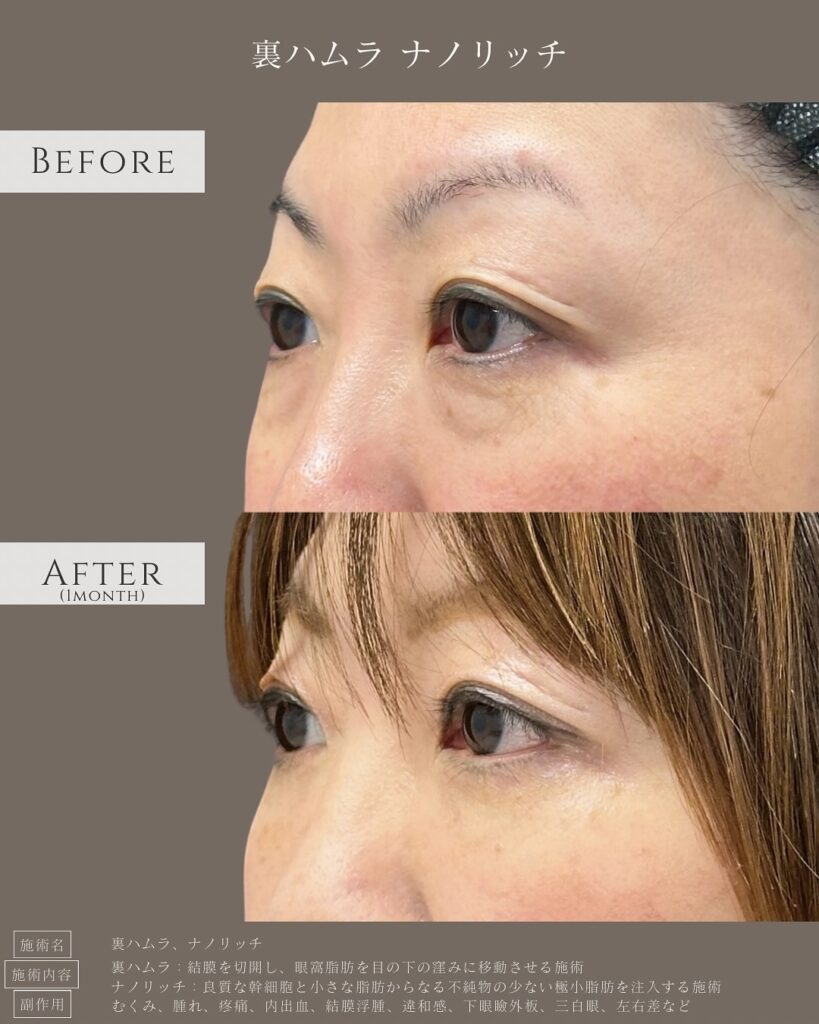 裏ハムラ法とナノリッチの症例写真 (16)