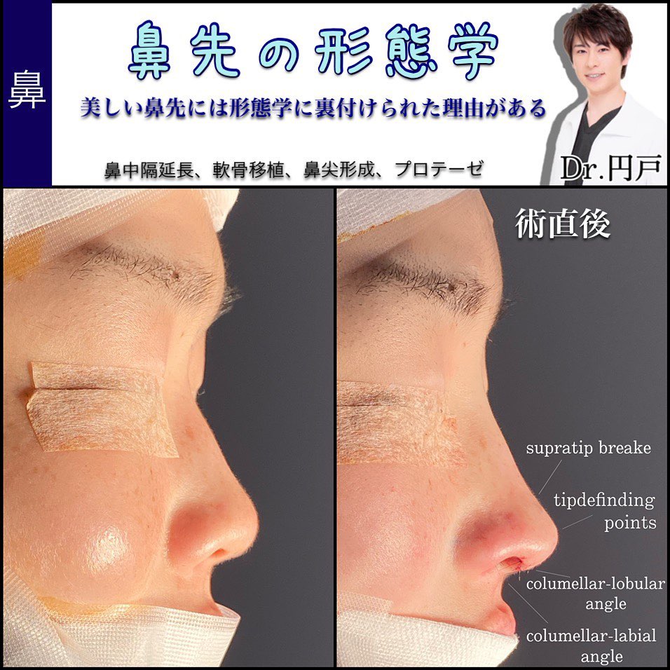 鼻中隔延長と軟骨移植と鼻尖形成と鼻のプロテーゼの症例写真