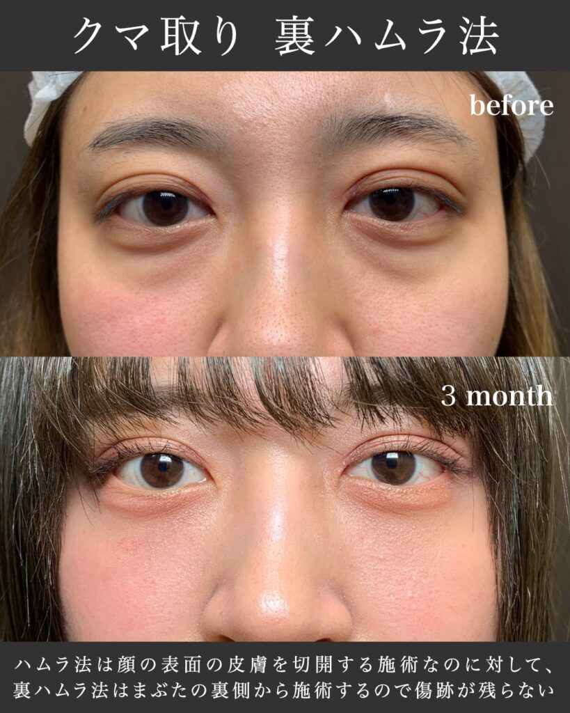 裏ハムラ法の症例写真