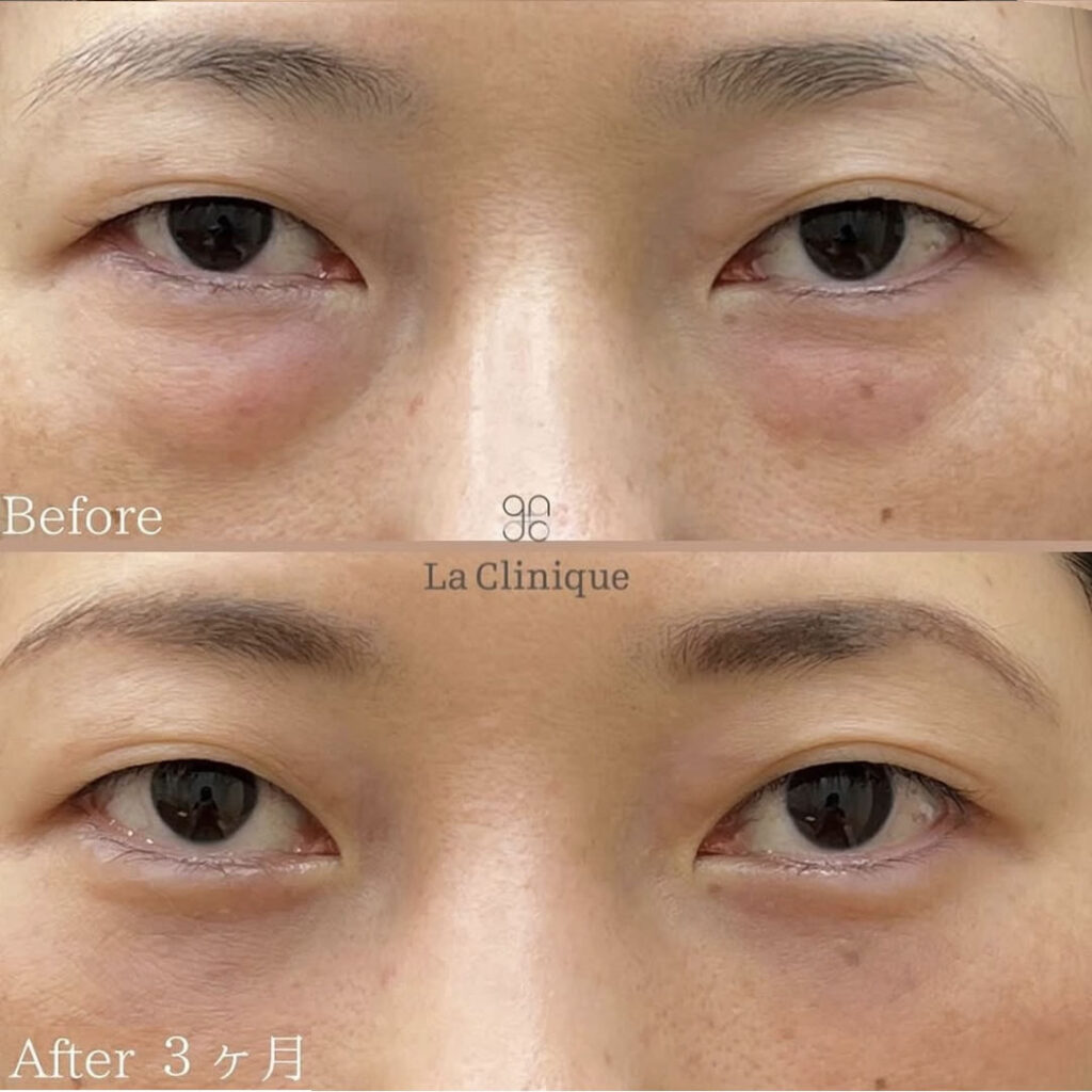 裏ハムラ法の症例写真