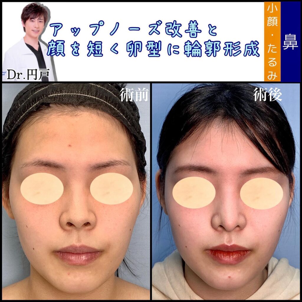 鼻の美容整形と額とこめかみの脂肪注入の症例写真 (2)