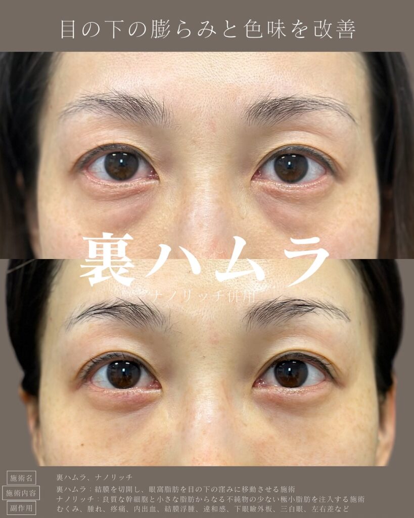 裏ハムラ法とナノリッチの症例写真 (19)