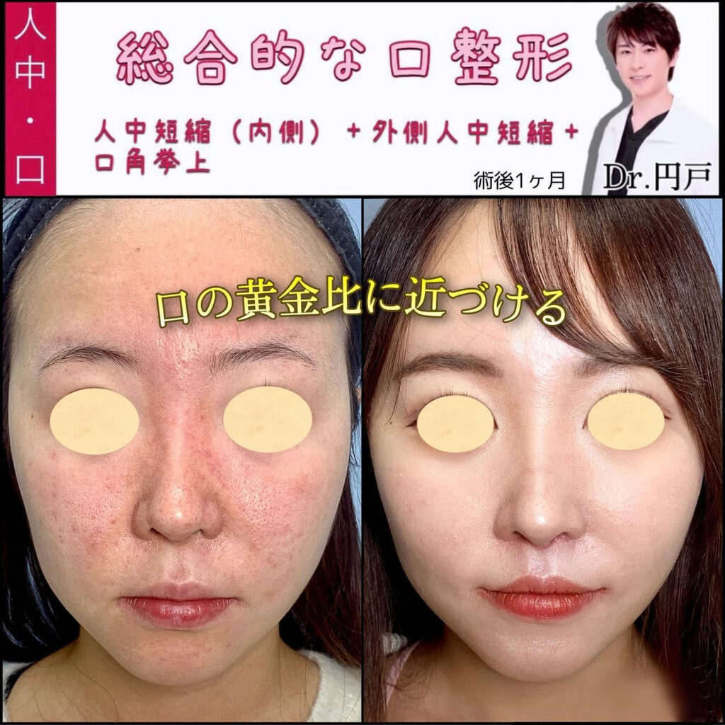内側人中短縮と外側人中短縮と口角挙上とM字リップ形成をして黄金比に近づけた症例写真