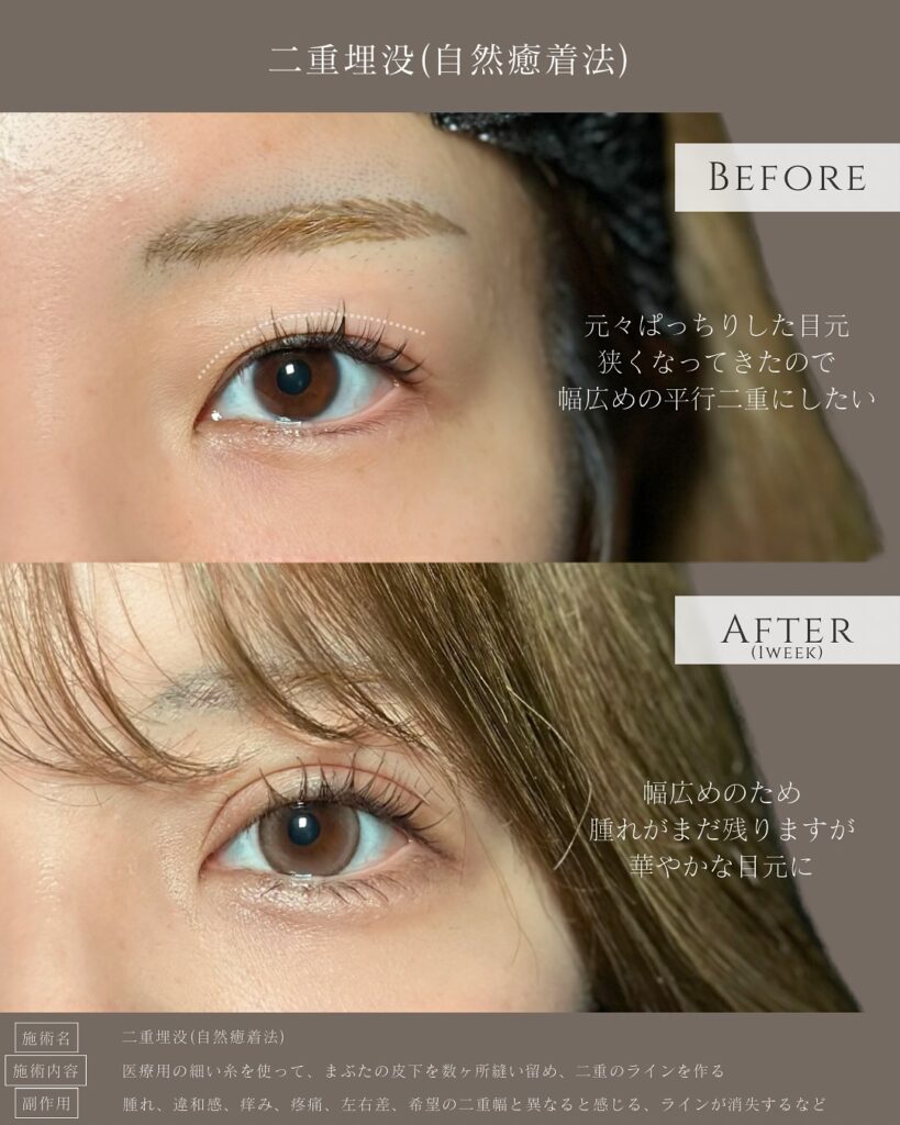 自然癒着法の症例写真 (10)