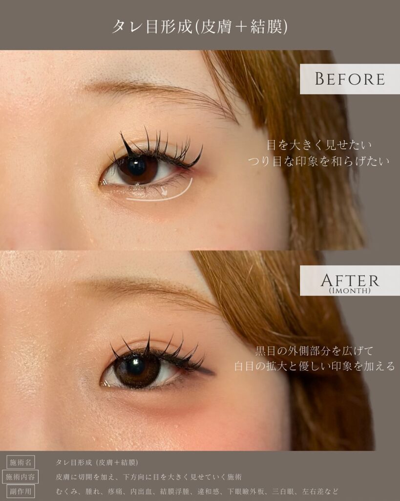 タレ目形成の症例写真 (10)