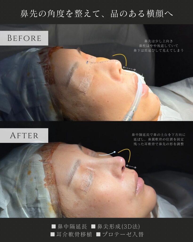 鼻中隔延長と鼻尖形成と耳介軟骨移植とプロテーゼの入れ替えの症例写真 (3)