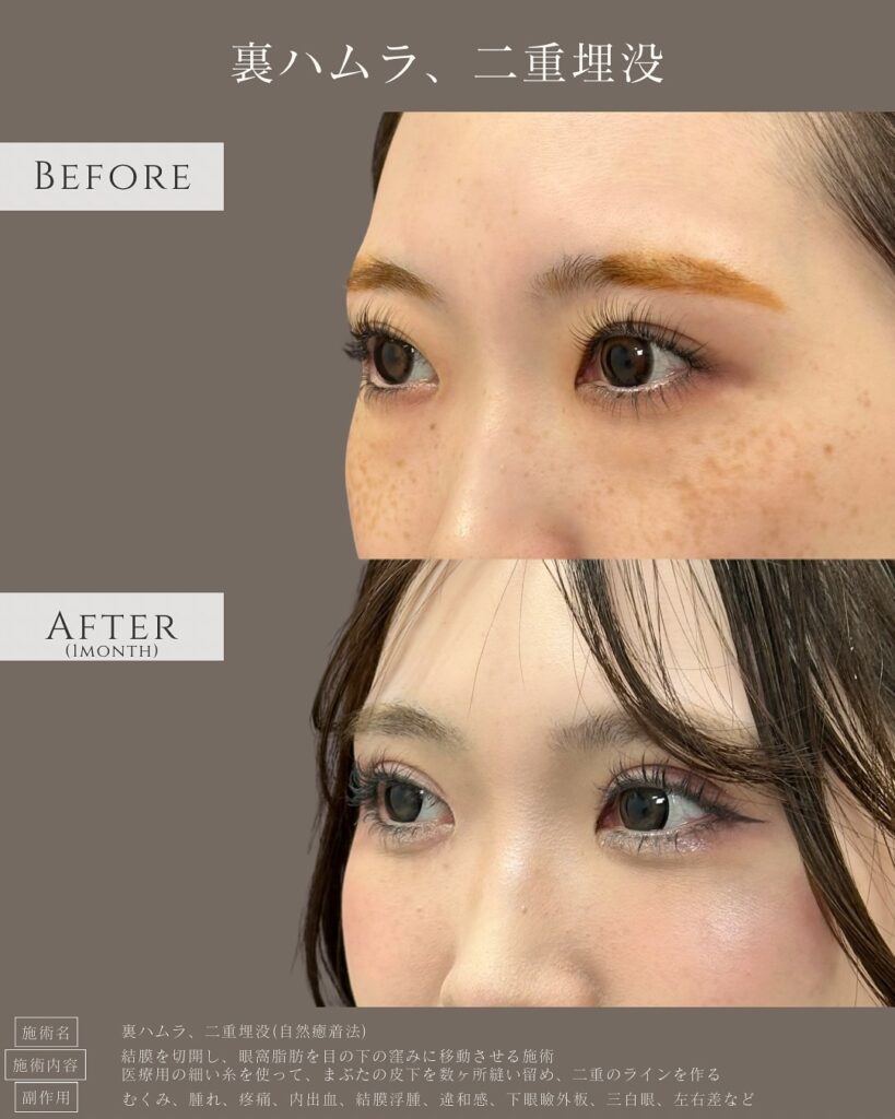 裏ハムラ法と自然癒着法の症例写真 (2)