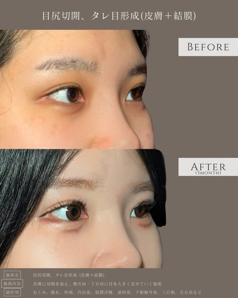 目尻切開とタレ目形成の症例写真 (13)
