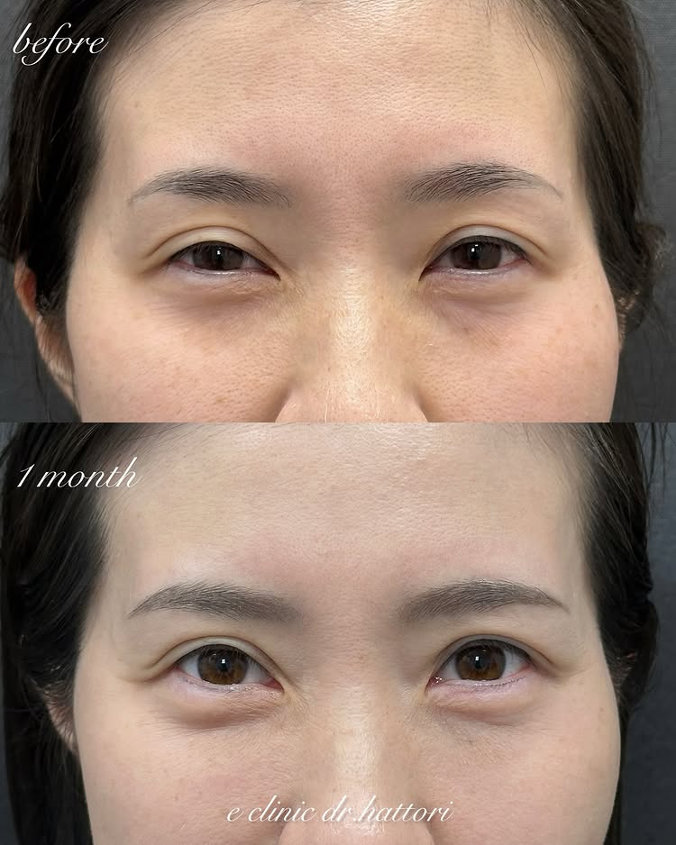 裏ハムラ法の症例写真 (64)