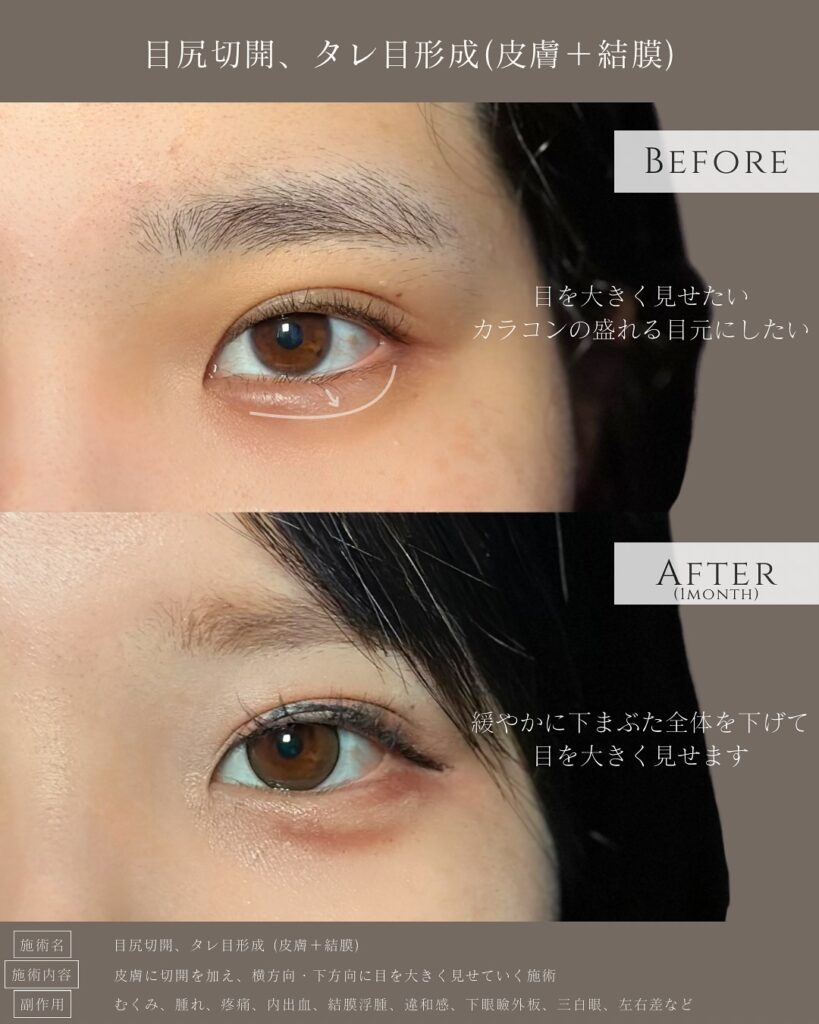 目尻切開とタレ目形成の症例写真 (15)