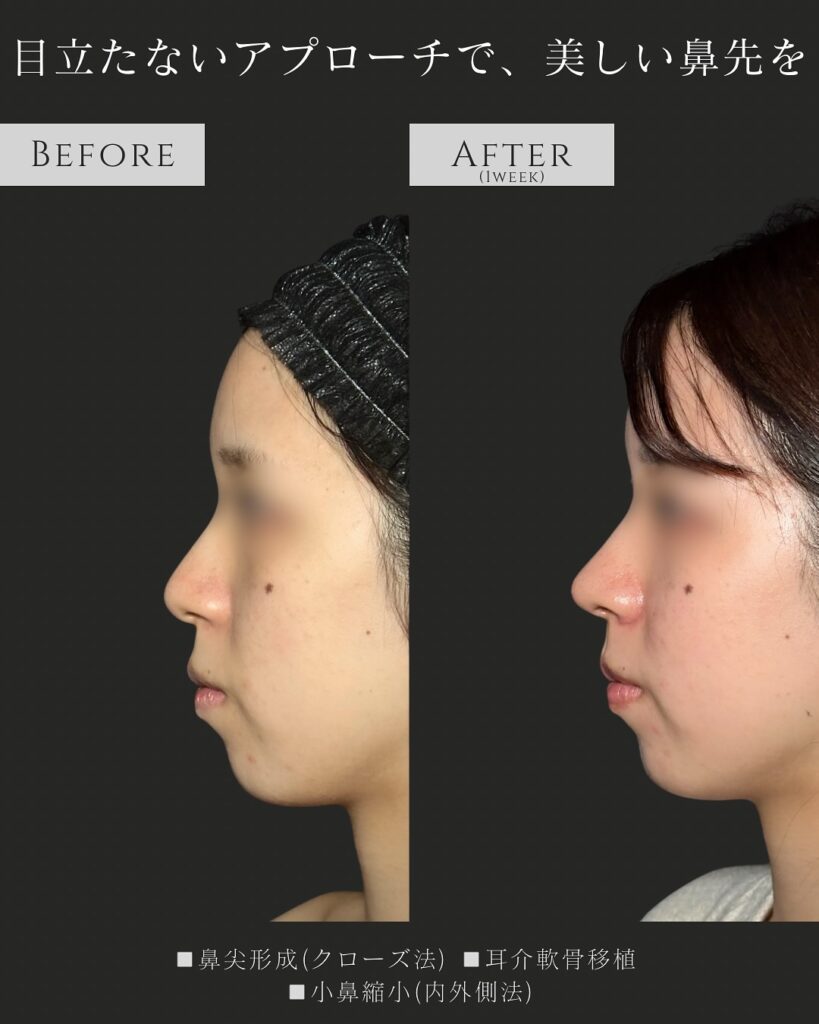 鼻尖形成と耳介軟骨移植と小鼻縮小の症例写真 (3)