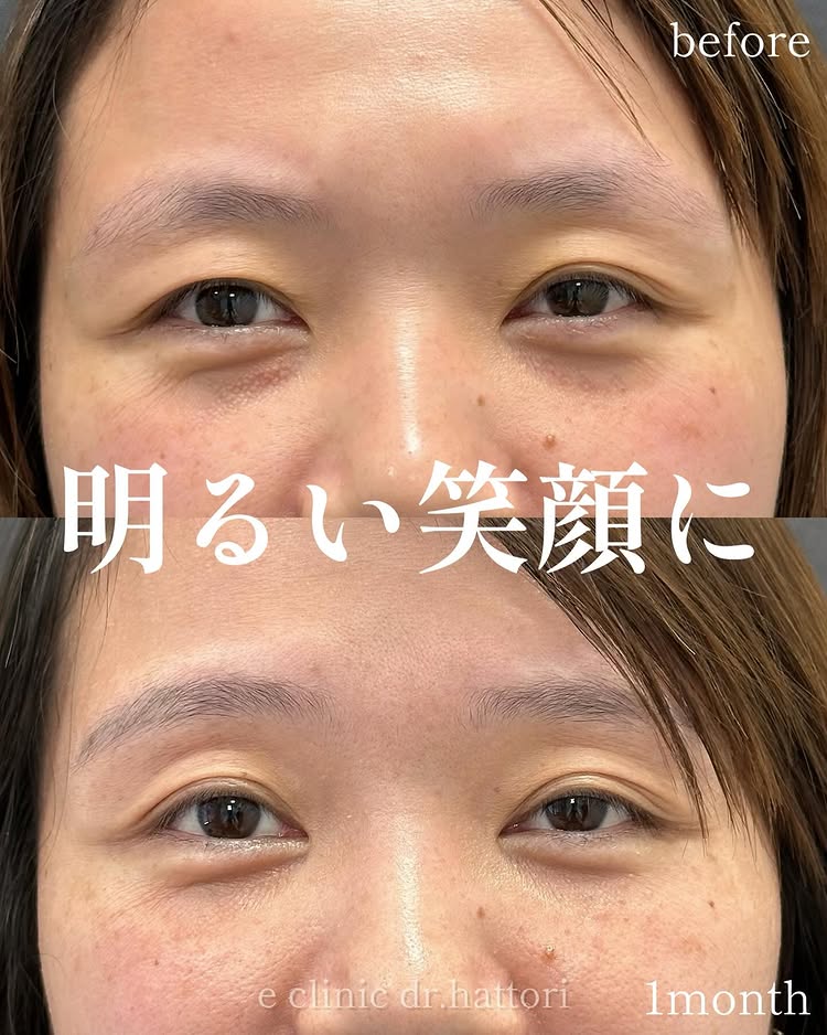 裏ハムラ法の症例写真 (72)