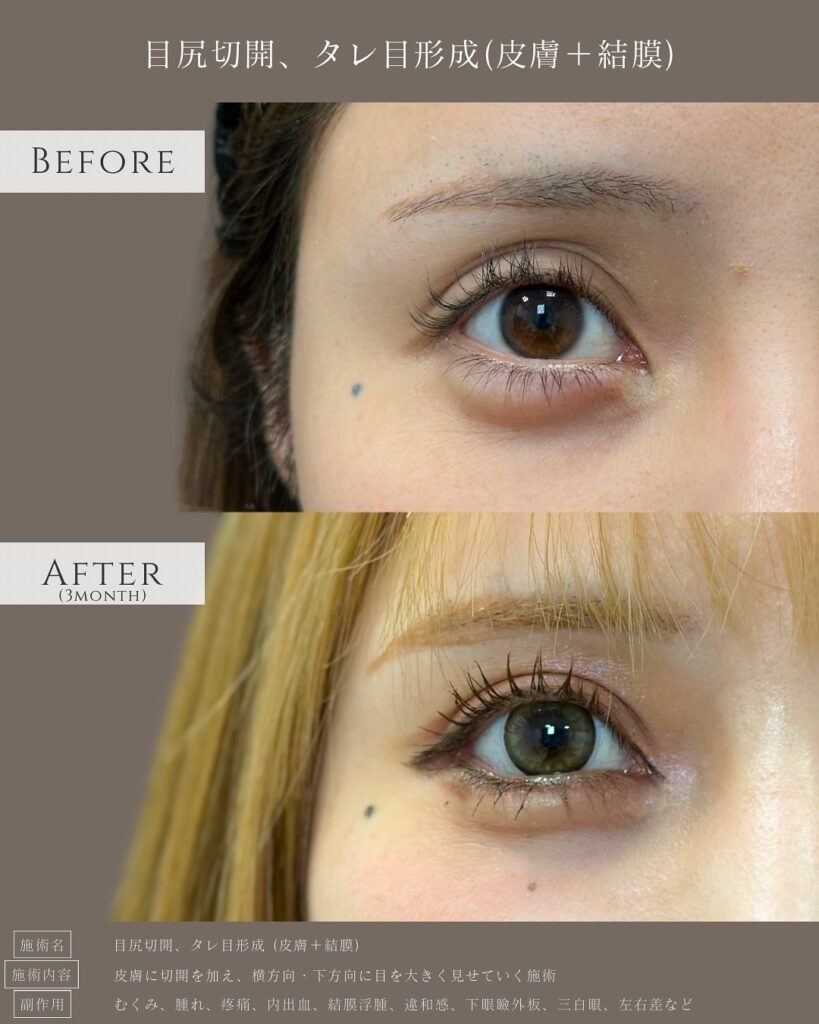目尻切開とタレ目形成の症例写真 (33)