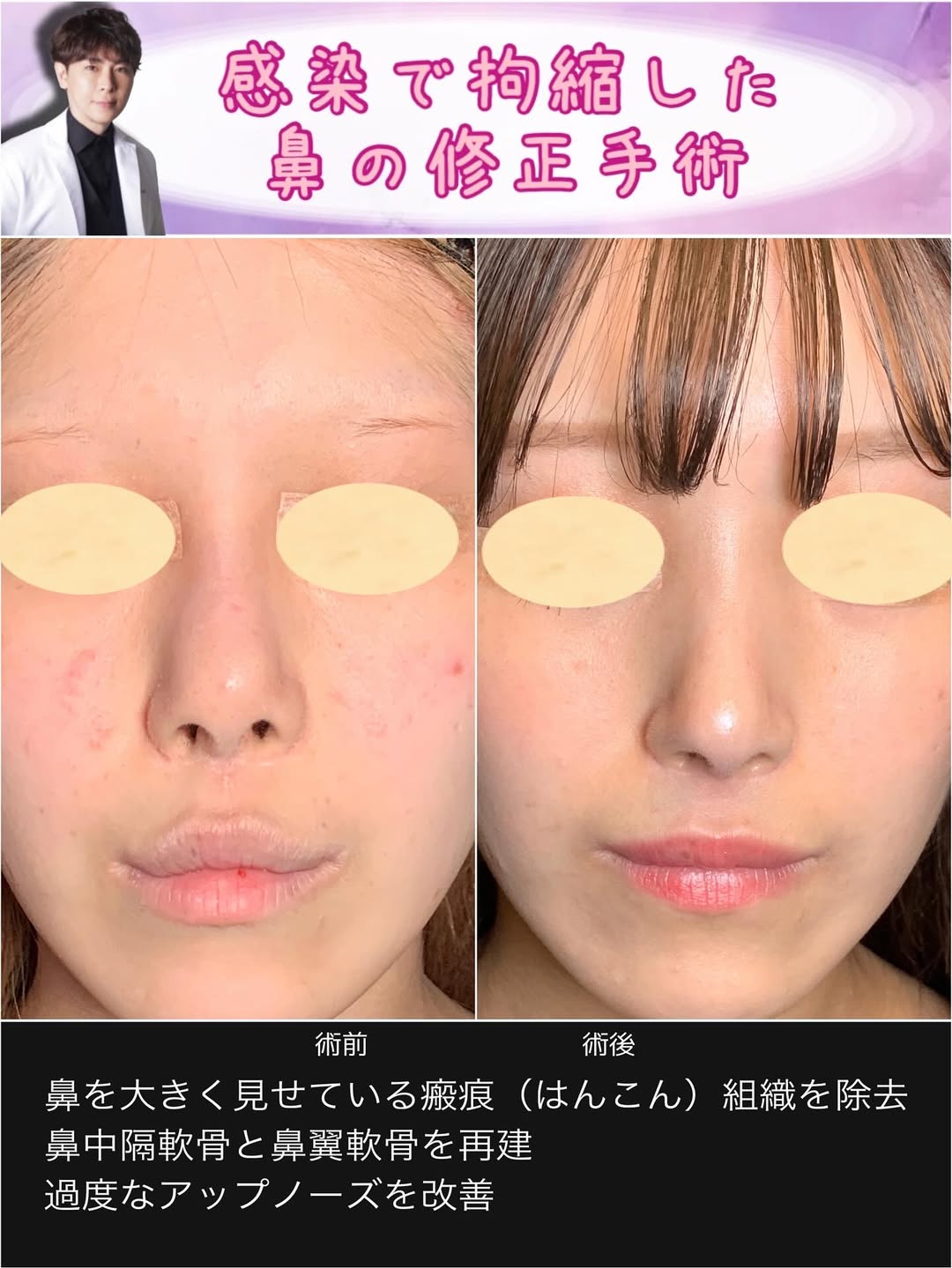 感染で拘縮した鼻の修正手術 | 名医がする鼻整形なら症例写真が豊富なe