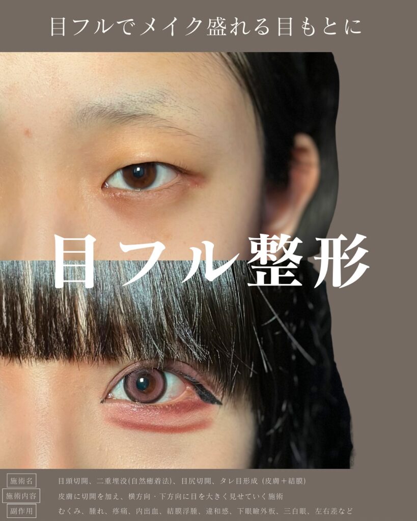 目頭切開と埋没法と目尻切開とタレ目形成の症例写真 (1)