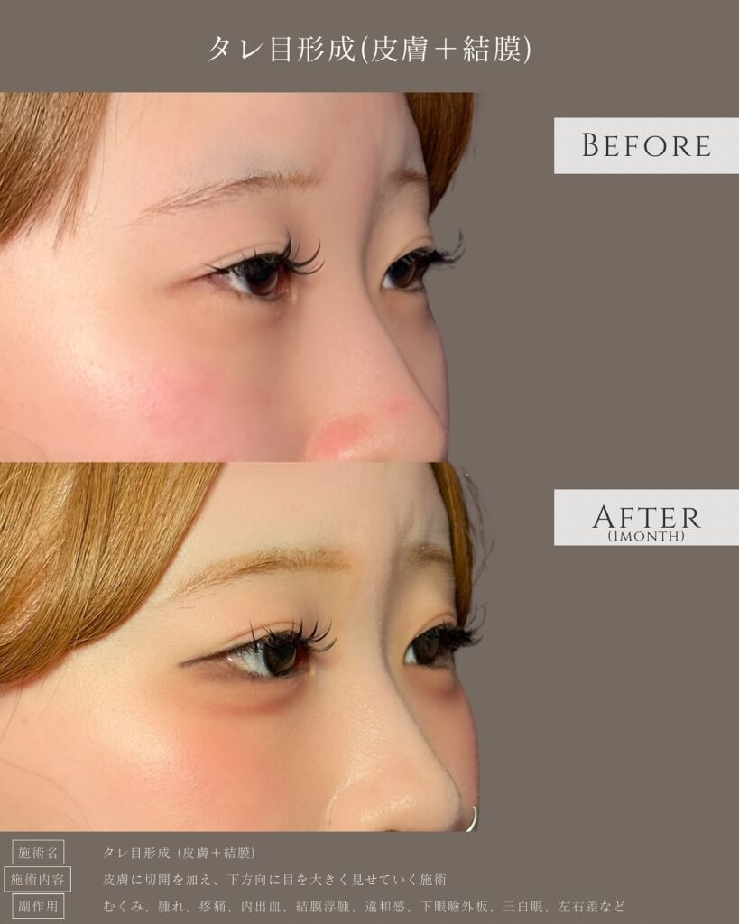 タレ目形成の症例写真 (8)