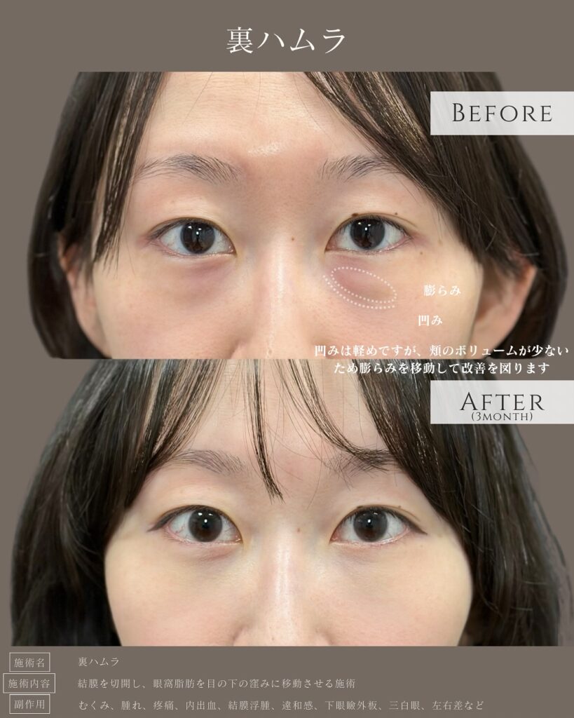 裏ハムラ法の症例写真 (30)