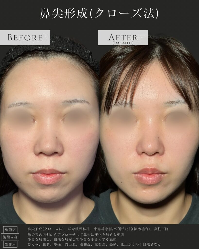 鼻尖形成と耳介軟骨移植と小鼻縮小と鼻柱下降の症例写真 (5)