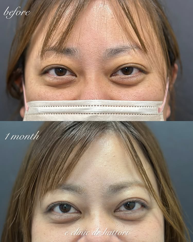 裏ハムラ法の症例写真 (61)