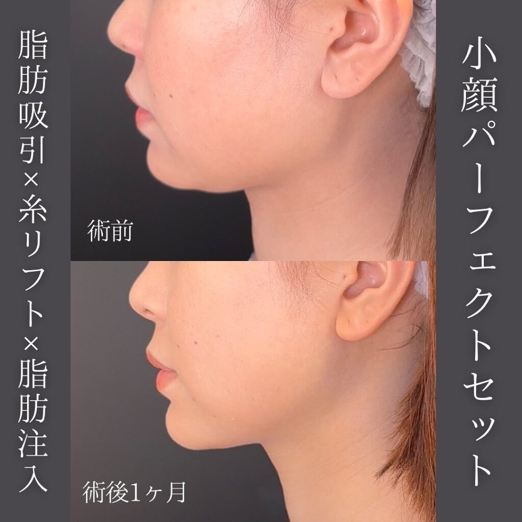 脂肪吸引と糸リフト