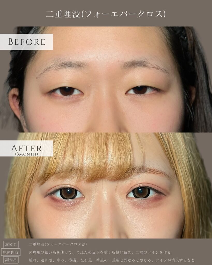 埋没法の症例写真 (5)