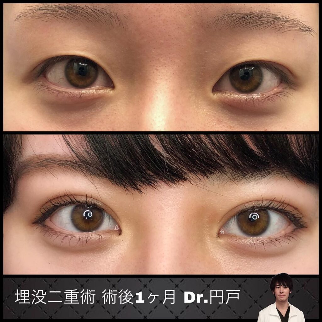 埋没法の症例写真 (5)