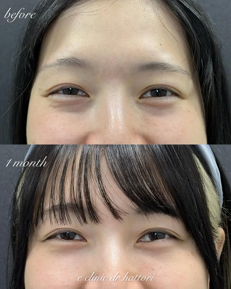 裏ハムラ法の症例写真 (68)