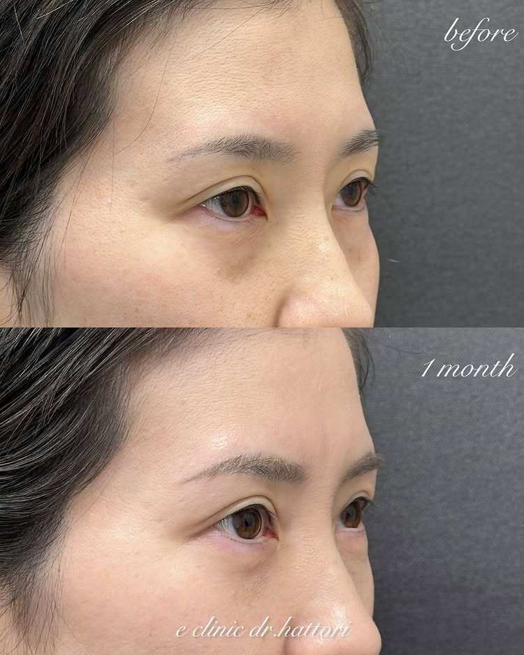 裏ハムラ法の症例写真 (62)