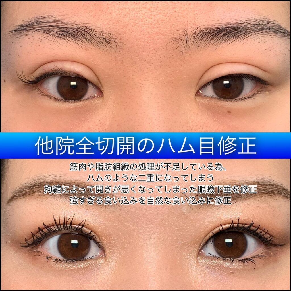 他院全切開のハム目修正 (2)