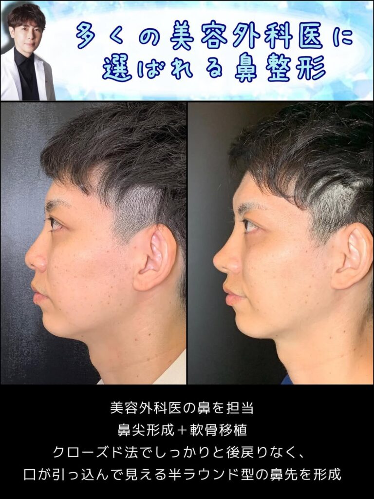 鼻尖形成と軟骨移植の症例写真 (2)