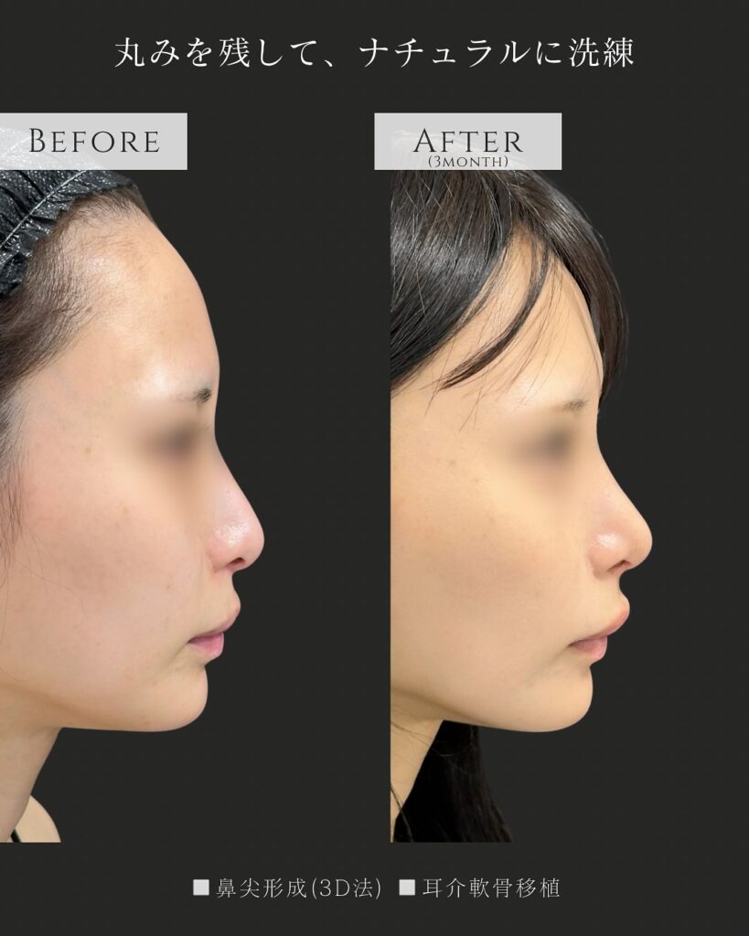 鼻尖形成と耳介軟骨移植の症例写真 (14)