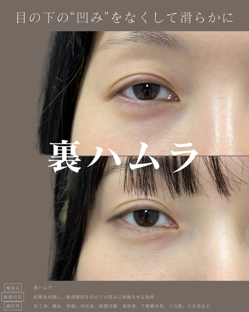 裏ハムラ法の症例写真 (47)