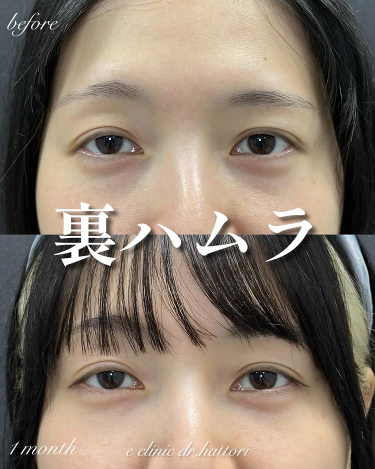 裏ハムラ法の症例写真 (66)