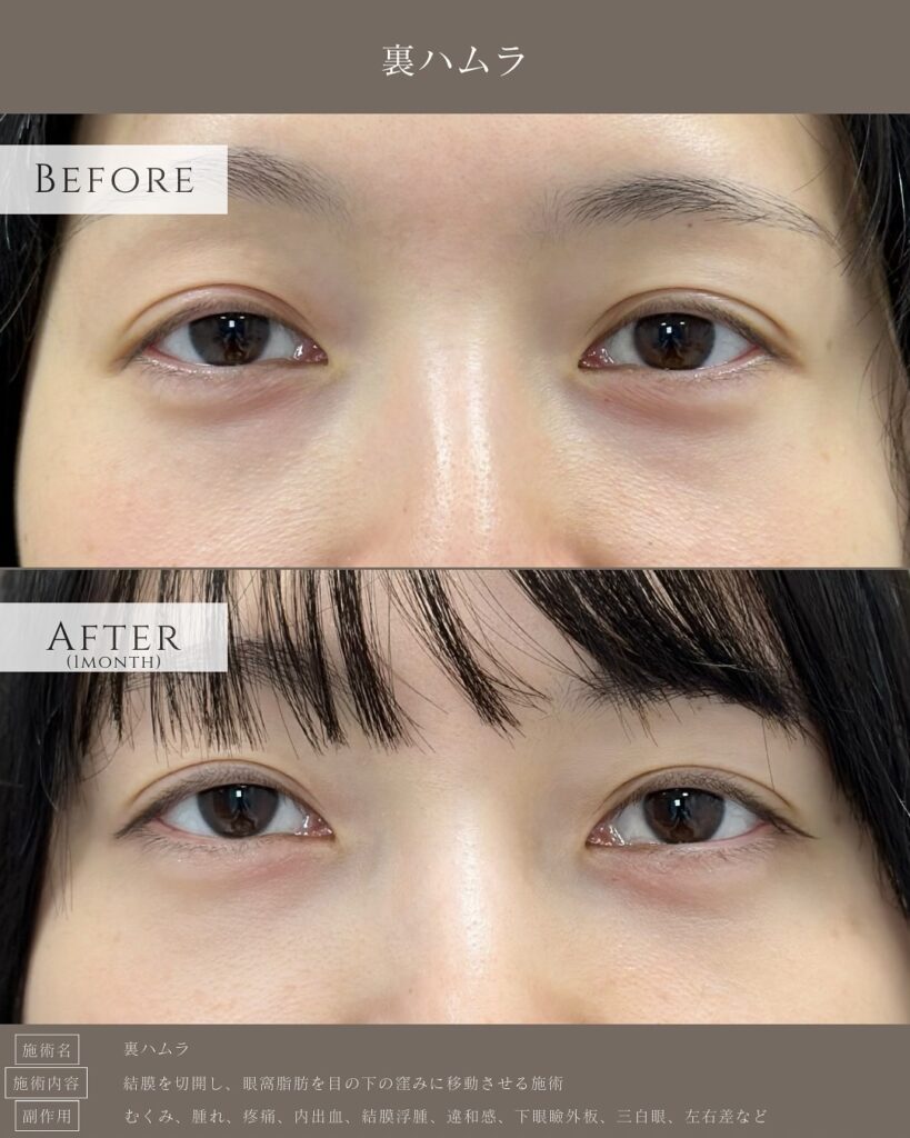 裏ハムラ法の症例写真 (48)