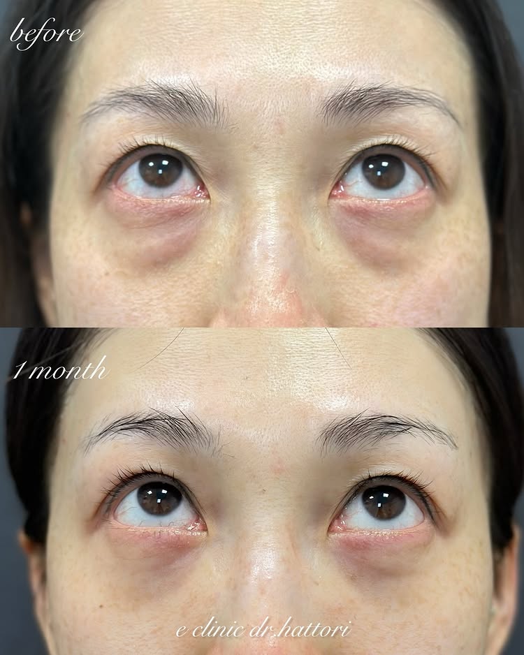 裏ハムラ法とナノリッチの症例写真 (23)